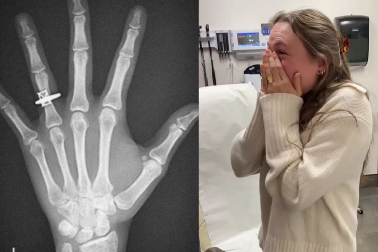Le hicieron una placa tras un accidente y descubrió un detalle en su mano que le cambió la vida