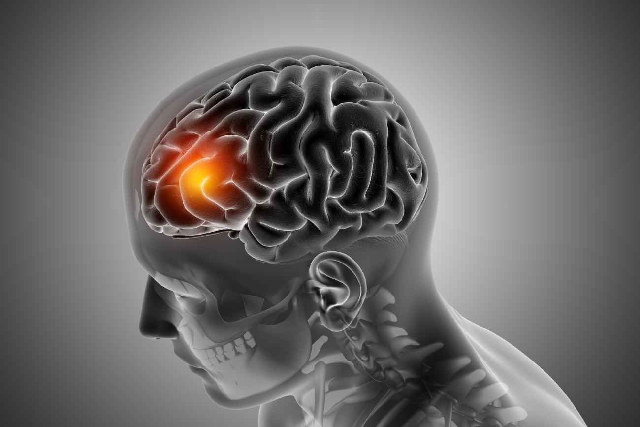 La esclerosis lateral amiotrófica (ELA) es una enfermedad rara y progresiva que se caracteriza por la degeneración de las células nerviosas del cerebro y la médula espinal. 