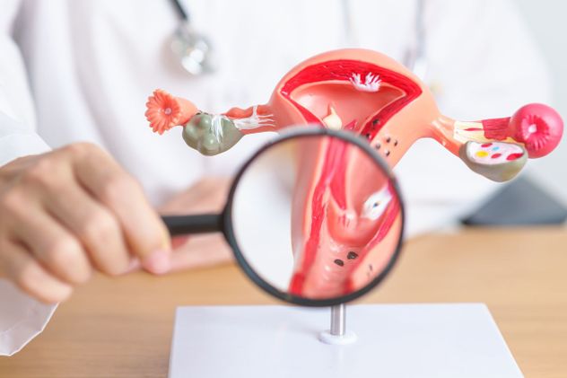 Endometriosis.
