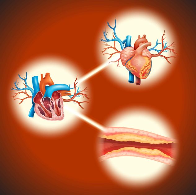 El colesterol alto, principalmente el LDL ("malo"), causa la acumulación de placa en las arterias (ateroesclerosis), lo que puede llevar a problemas graves.