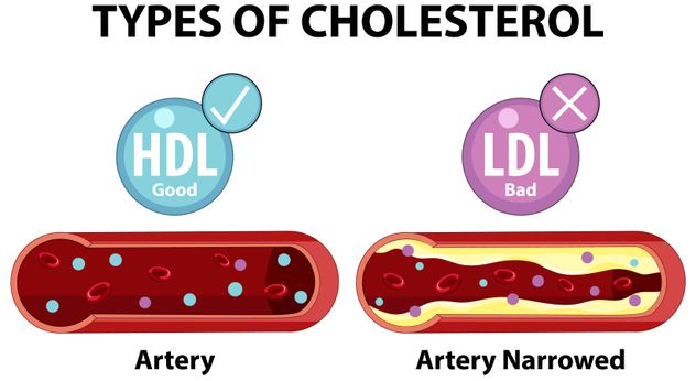 El colesterol alto, principalmente el LDL ("malo"), causa la acumulación de placa en las arterias (ateroesclerosis), lo que puede llevar a problemas graves.