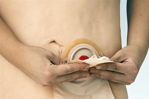 Pami: cómo acceder a insumos gratis para ostomía paso a paso.