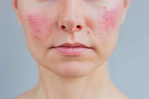La rosácea afecta a miles de personas, pero sigue infradiagnosticada por confundirse con una piel sensible o por un simple rubor facial.