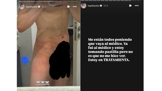 Martín Cirio compartió en Instagram las extrañar ronchas que salieron en su piel.