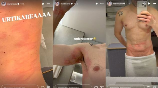 Martín Cirio compartió en Instagram las extrañar ronchas que salieron en su piel.