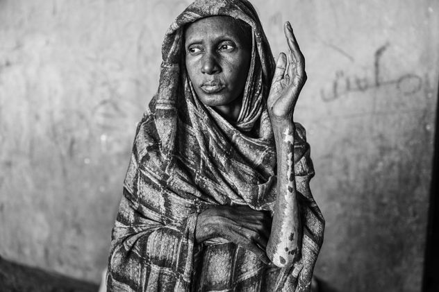 17- Alhaja Abdallah, una mujer desplazada de Bara, muestra las cicatrices de un incendio en el campamento de Al-Mohad, en El-Obeid, Sudán. Las fuerzas paramilitares de RSF han incendiado varios campamentos de desplazados. 