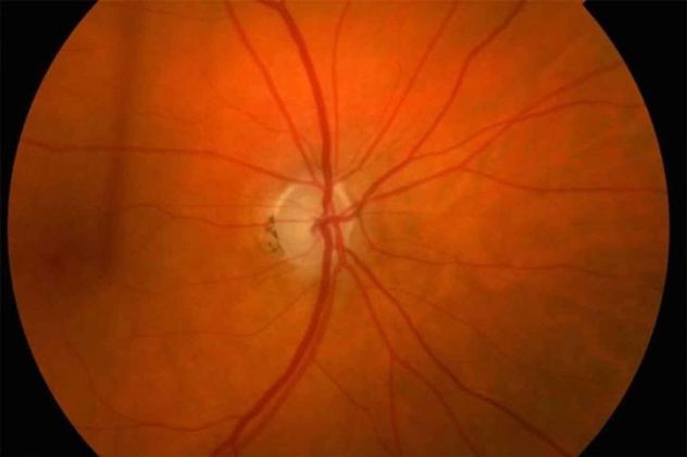 El glaucoma es una enfermedad ocular en la cual la presión intraocular suele estar elevada y que daña en forma progresiva el nervio óptico.