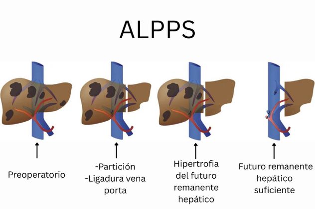 Cirugía hepática ALPPS.