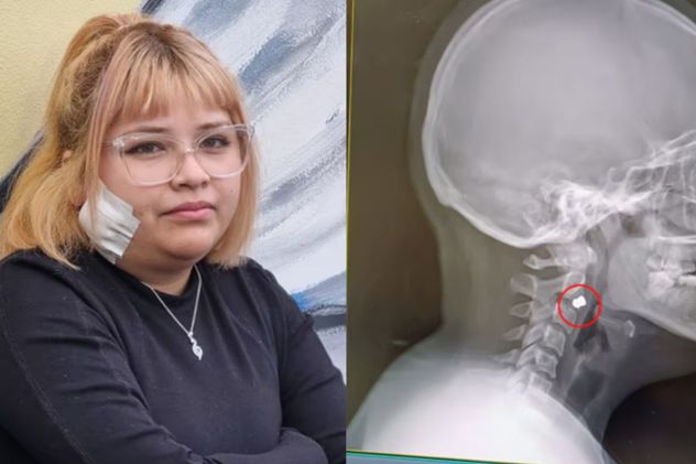 La joven denunció que el proyectil le quedó alojado en la mandíbula. 