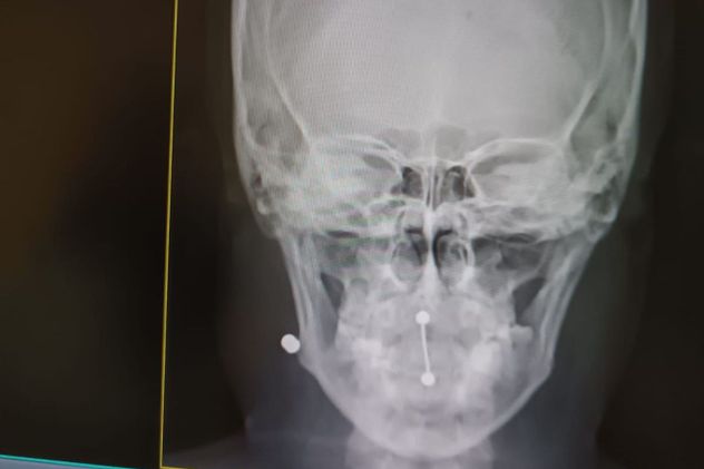 Milagros aún tiene alojado un balín en su cuello.
