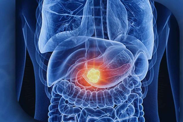 Un estudio detectó mejoras en el páncreas de pacientes con diabetes tipo 2 que seguían una dieta cetogénica. 