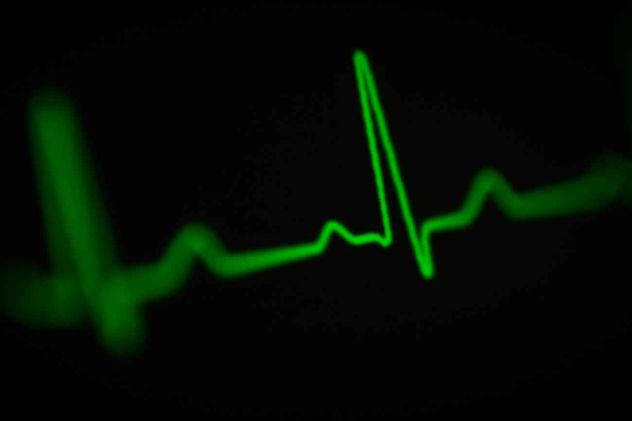 Tanto el ritmo cardíaco muy lento como el muy acelerado disparan hasta un 45% el riesgo de sufrir un ictus.