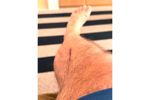 La foto que Darío Barassi compartió de la cicatriz de su pierna.