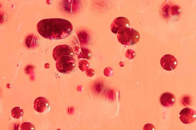 Mielofibrosis y anemia. 