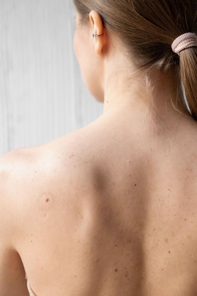 El Día Mundial del Melanoma se conmemora cada 23 de mayo. 