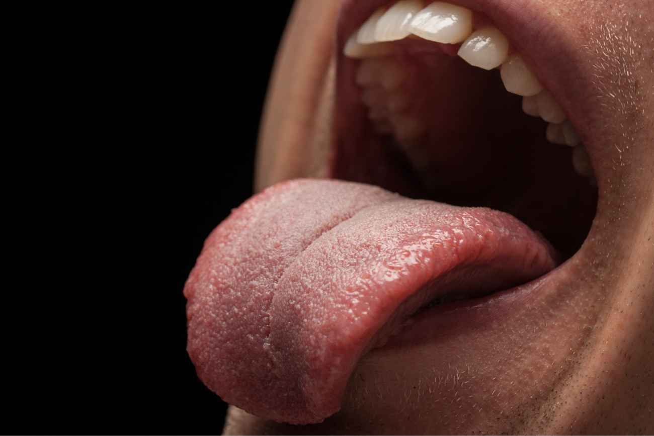 La boca seca puede causar caries, halitosis o dificultad al tragar. 