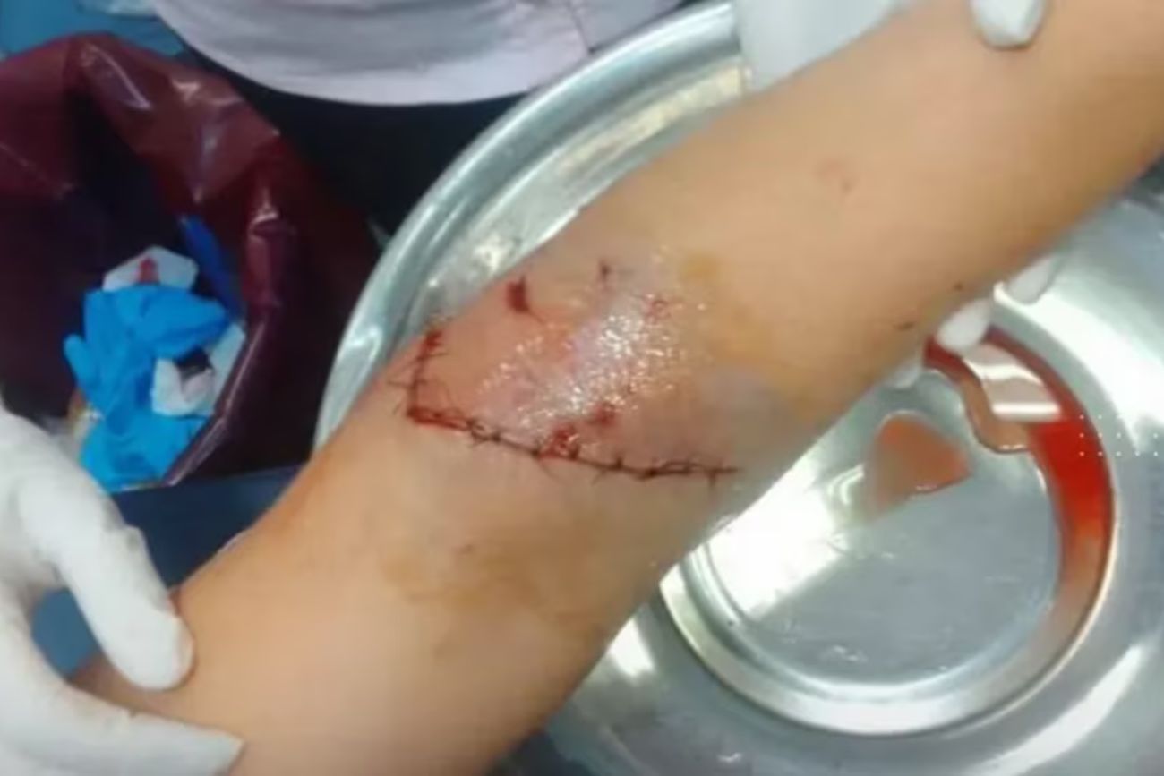 “Me veía hasta el hueso”: una mujer fue atacada por dos perros y sufrió graves heridas