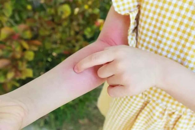 La psoriasis afecta aproximadamente al 2% o 3% de la población argentina (cerca de 1 millón de personas).