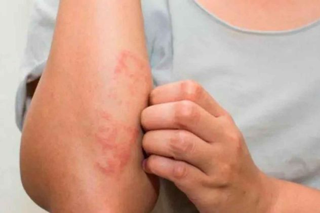 La psoriasis afecta aproximadamente al 2% o 3% de la población argentina (cerca de 1 millón de personas).