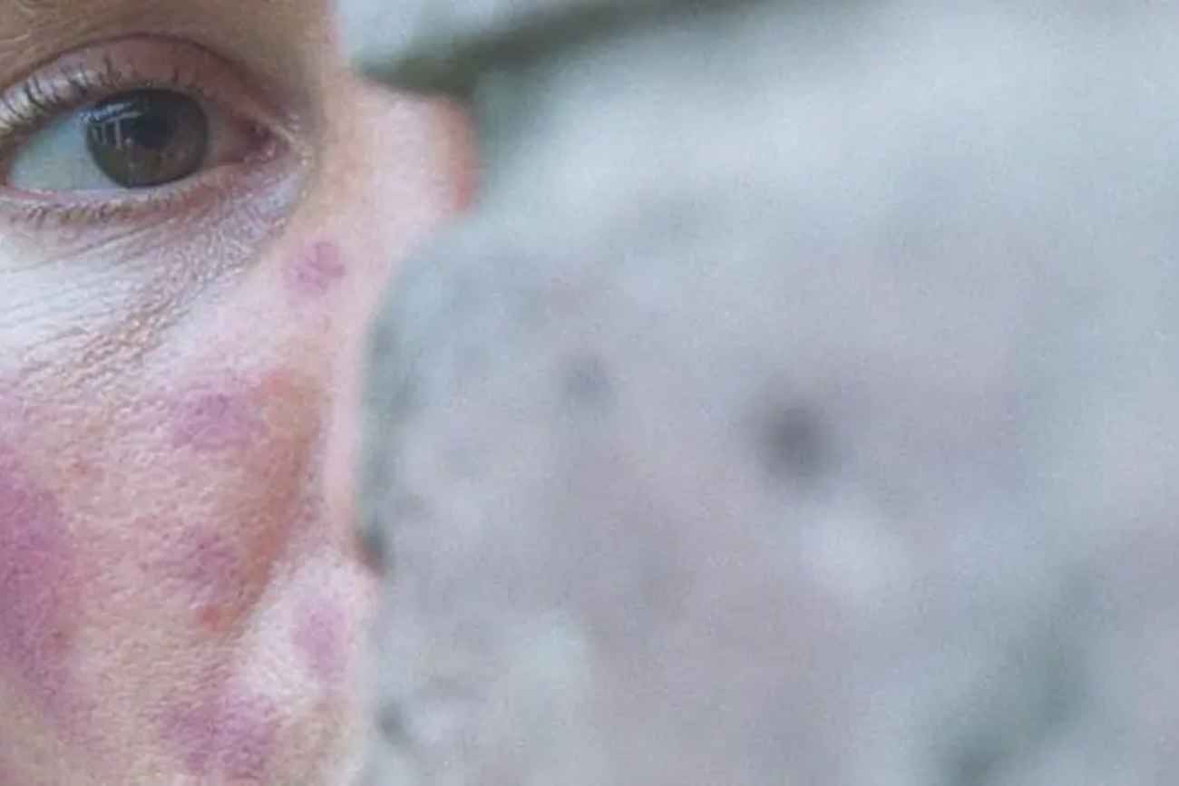 La psoriasis afecta aproximadamente al 2% o 3% de la población argentina (cerca de 1 millón de personas).