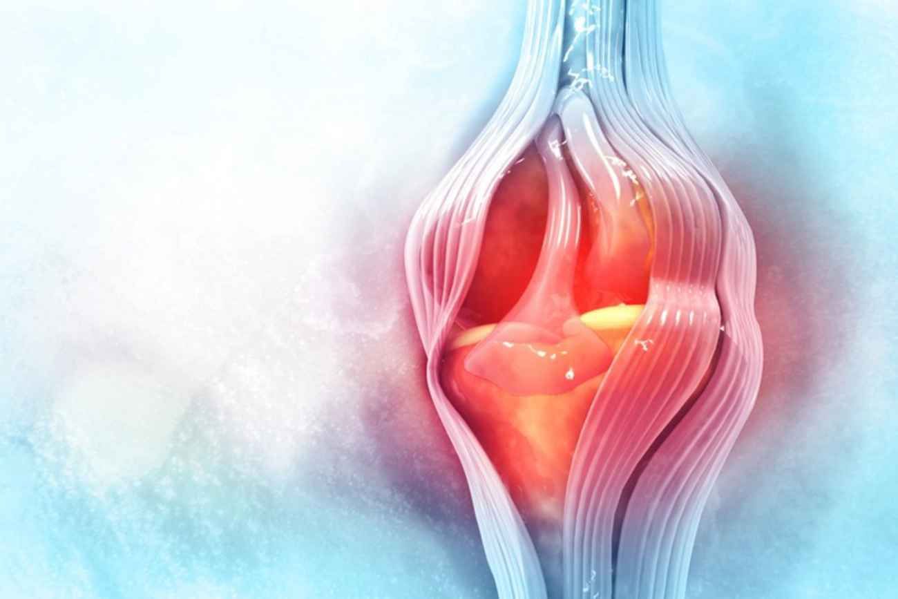Artrosis de rodilla. 