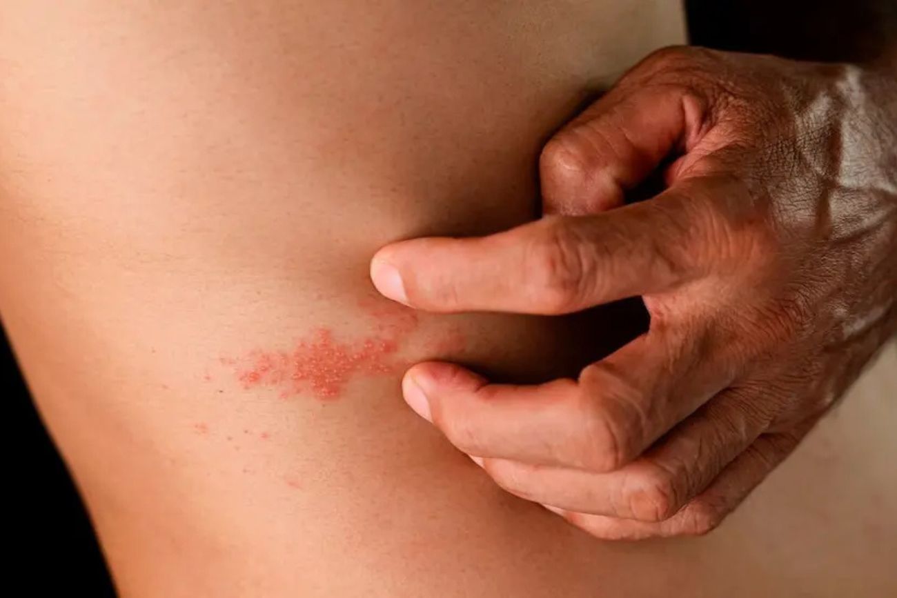 Herpes zóster. 