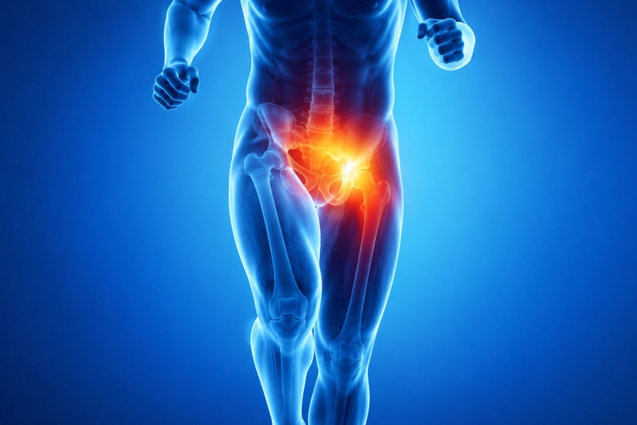 La pubalgia es una lesión frecuente en personas que practican deporte y puede involucrar distintas estructuras de la pelvis, la cadera y la región inguinal.