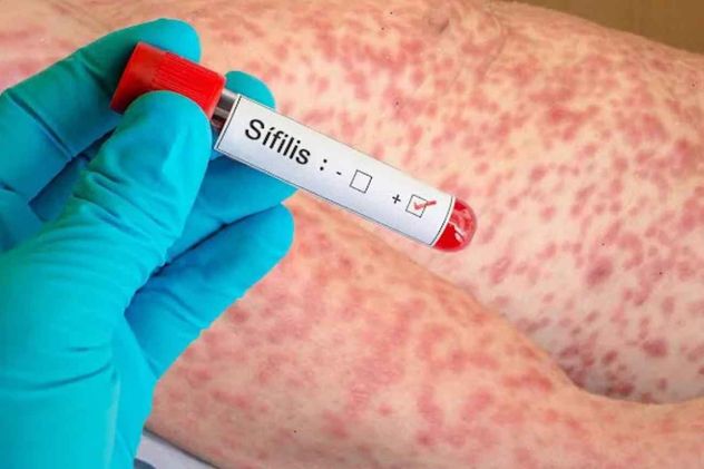 La sífilis es una infección de transmisión sexual (ITS) curable, provocada por la bacteria Treponema pallidum. Se transmite por contacto sexual sin protección o de madre a hijo durante el embarazo.