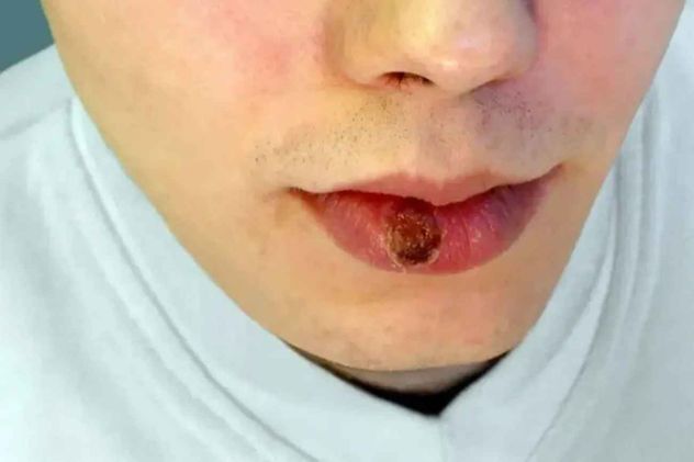 La sífilis es una infección de transmisión sexual (ITS) curable, provocada por la bacteria Treponema pallidum. Se transmite por contacto sexual sin protección o de madre a hijo durante el embarazo.