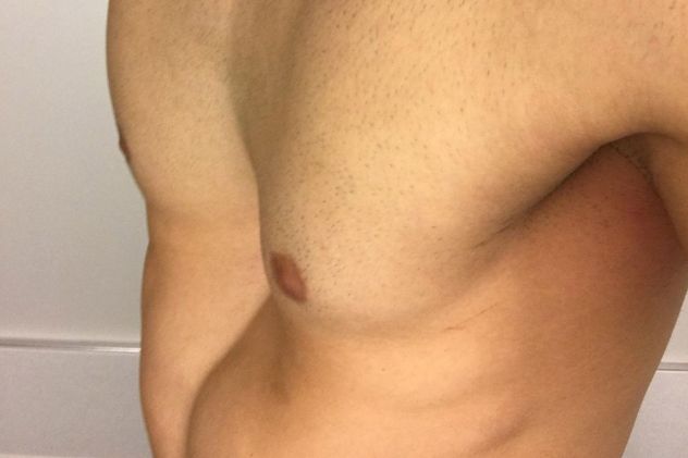 Sanatorio Allende ya emplea técnicas de vanguardia y crioanalgesia para la corrección del Pectus Excavatum, garantizando un procedimiento seguro y un postoperatorio libre de dolor.