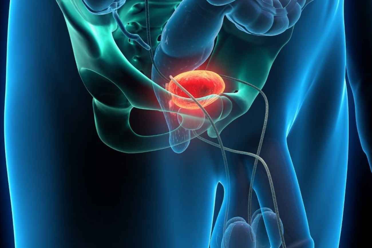 El cáncer de próstata avanza hacia tratamientos cada vez más personalizados.