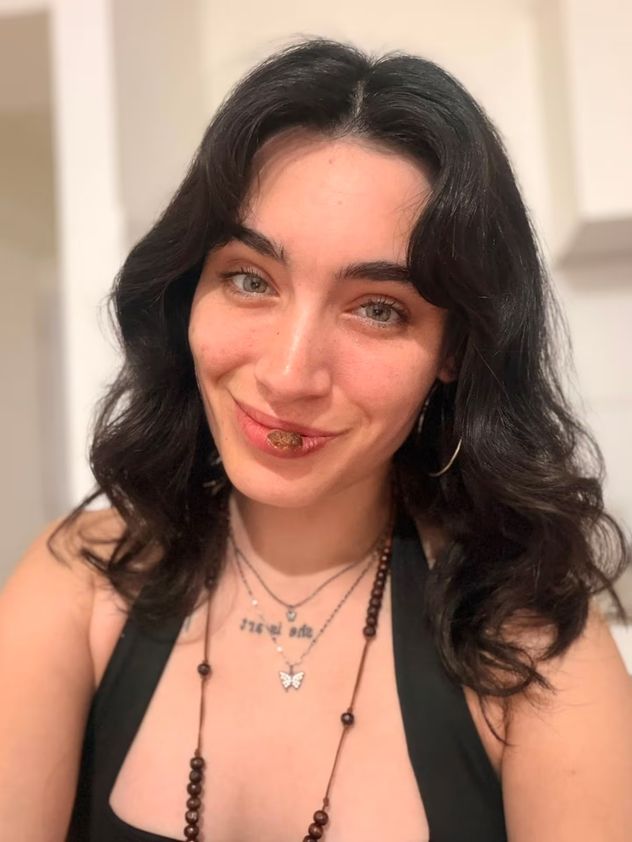 Se mordió el labio por estrés, pensó que era herpes y el diagnóstico fue sífilis: el caso que se volvió viral