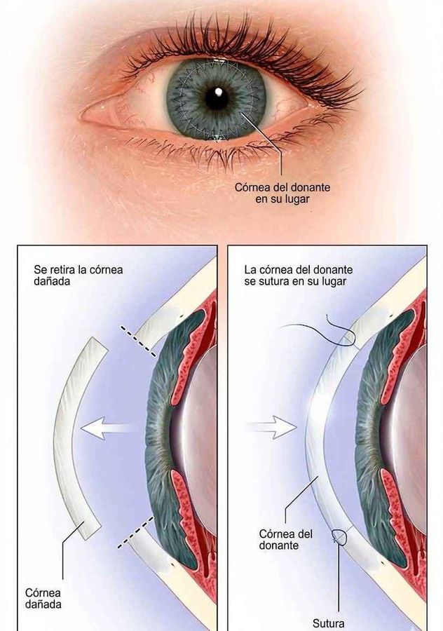 En Argentina, 2.200 personas actualmente esperan un trasplante de córnea.
