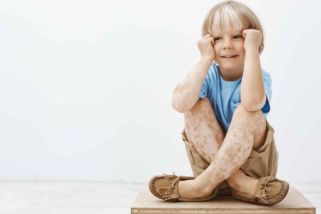 Día Mundial del Vitiligo. Los mitos que todavía generan discriminación y afectan la salud emocional.