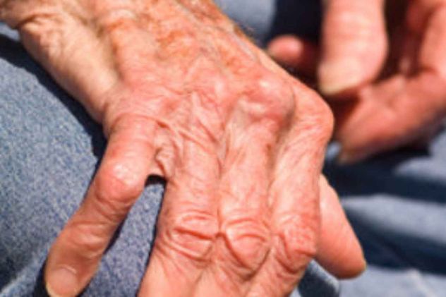 Muchos experimentan más molestias articulares durante el invierno. 