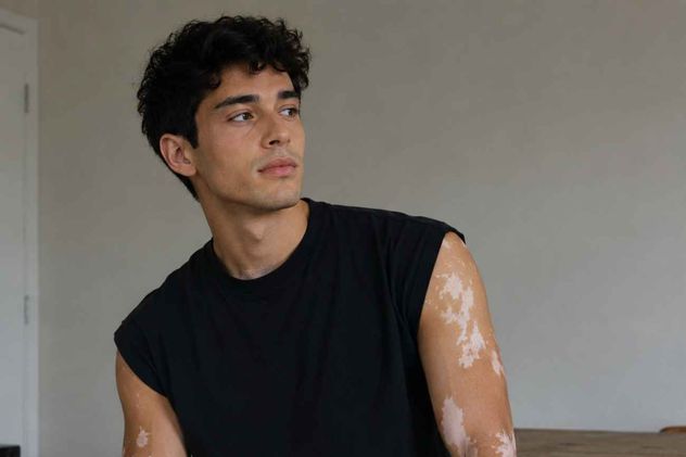 Día Mundial del Vitiligo. Los mitos que todavía generan discriminación y afectan la salud emocional.