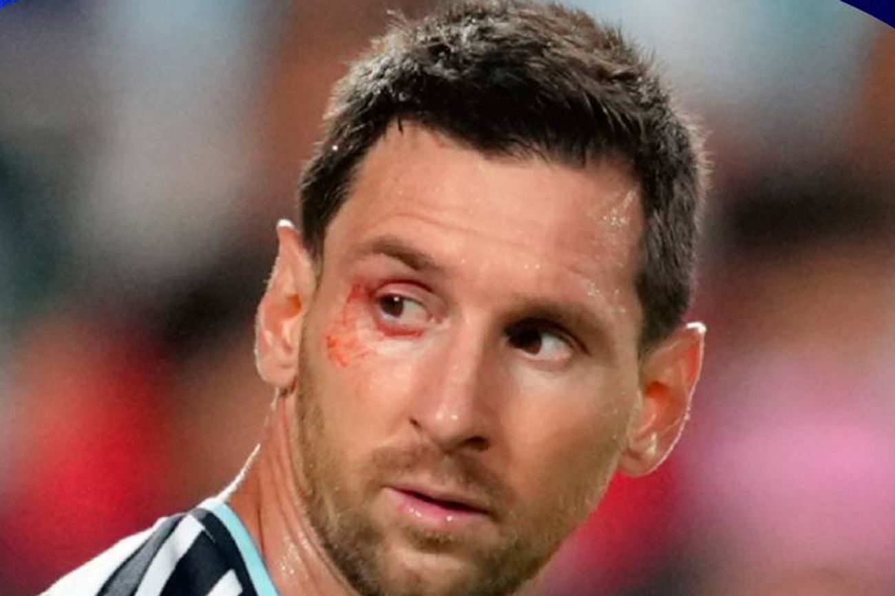 Messi y un corte en su ojo.