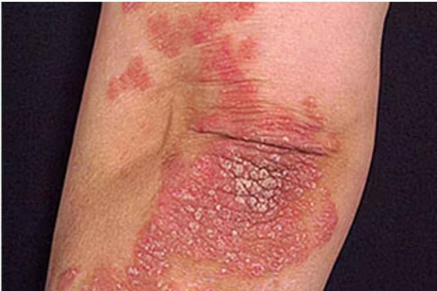 Artritis psoriásica.