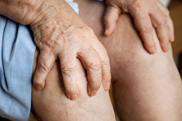 Artritis psoriásica. 