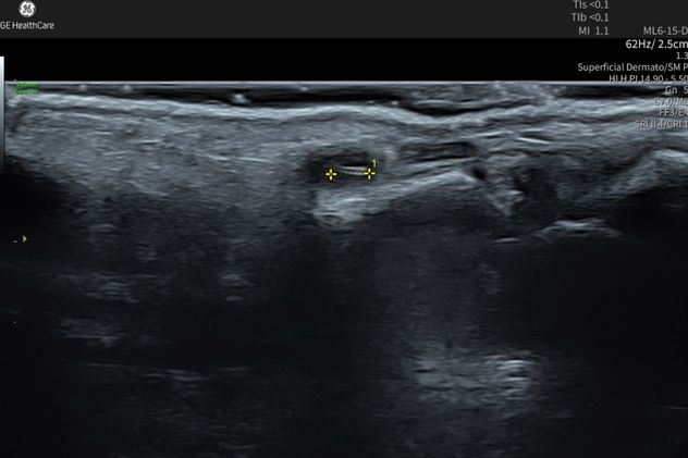 La ecografía dermatológica permite observar en tiempo real las distintas capas de la piel y los tejidos subyacentes mediante ultrasonido de alta frecuencia.