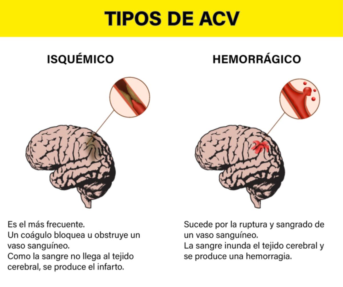 Qué es un ACV isquémico