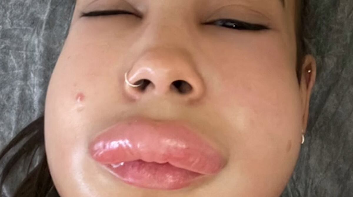 Una joven intervino sus labios, y una reacción la dejó deformada. (@isispolivx)