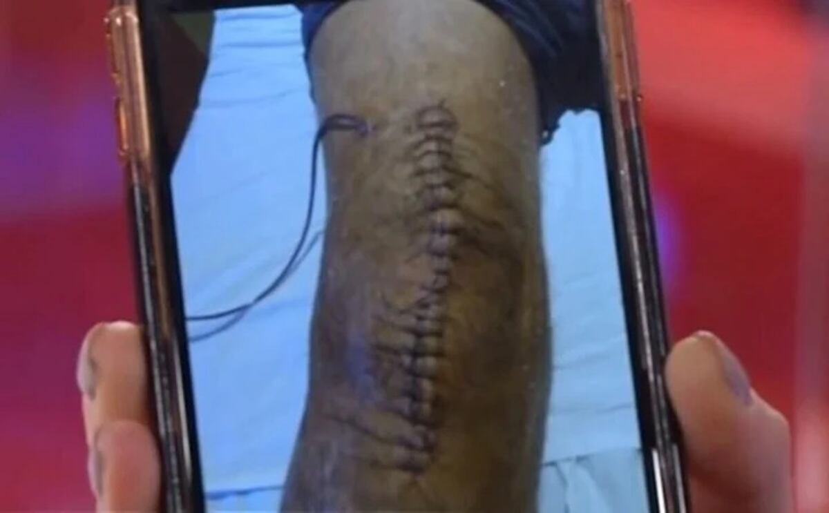 Impactante. Así luce la rodilla de Miguel del Sel.