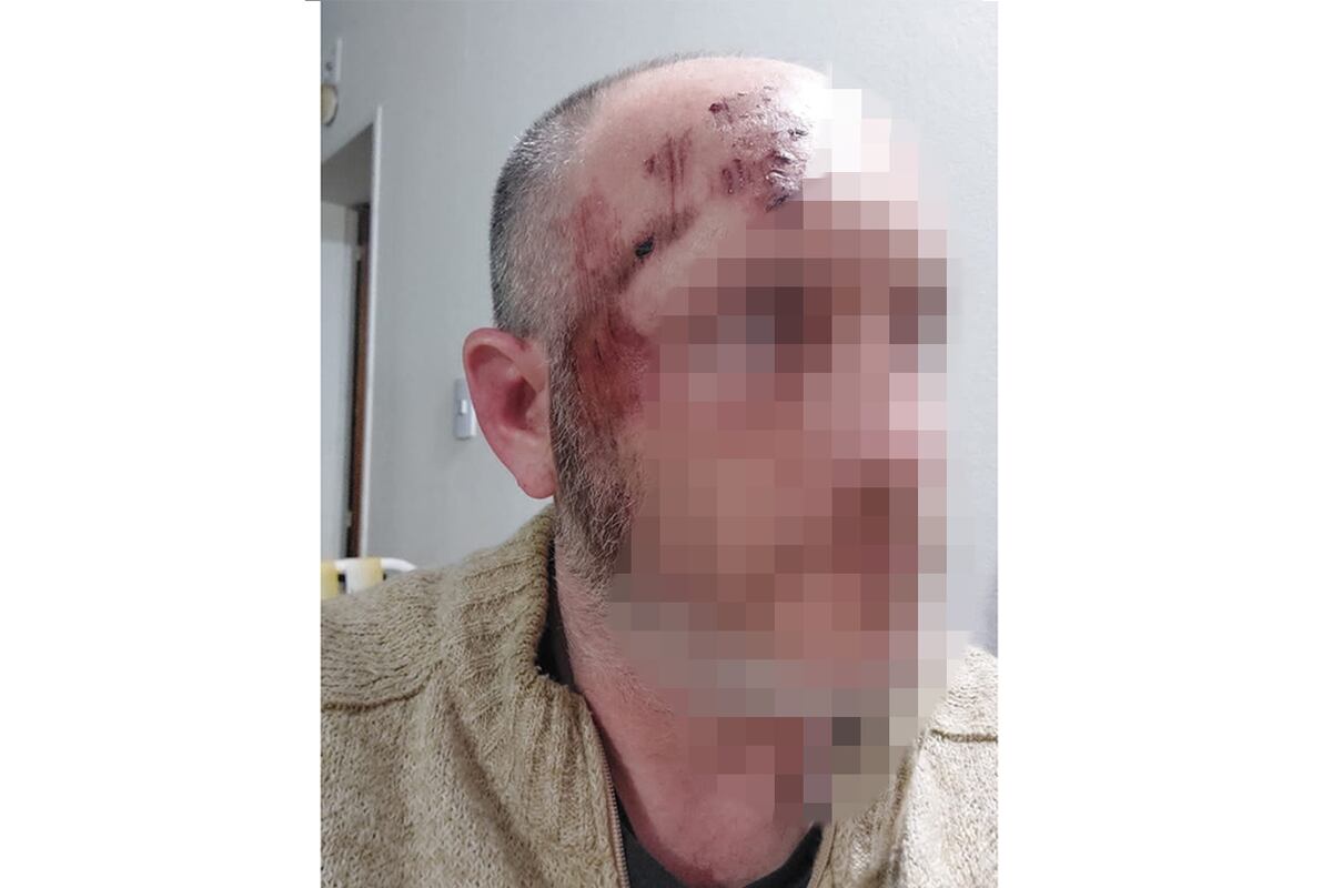 Heridas. Así quedó Pablo Norte, tras salvar al bebé. (Archivo)