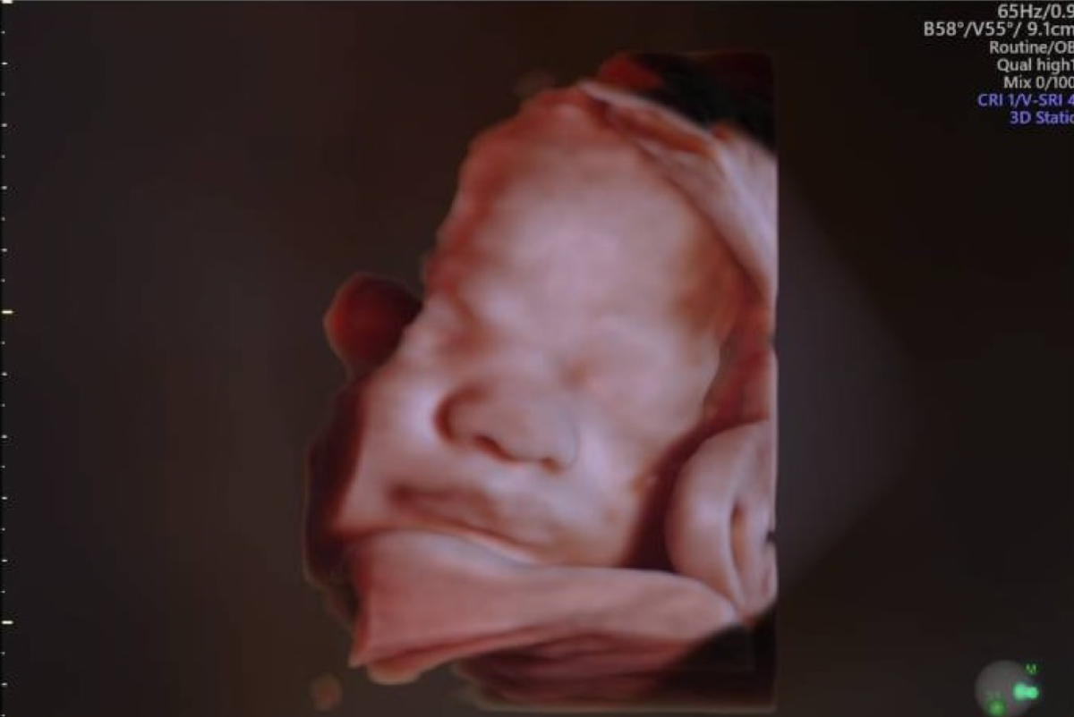Tecnología 5D y técnicas de resonancia magnética en medicina materno-fetal. / Sanatorio Allende