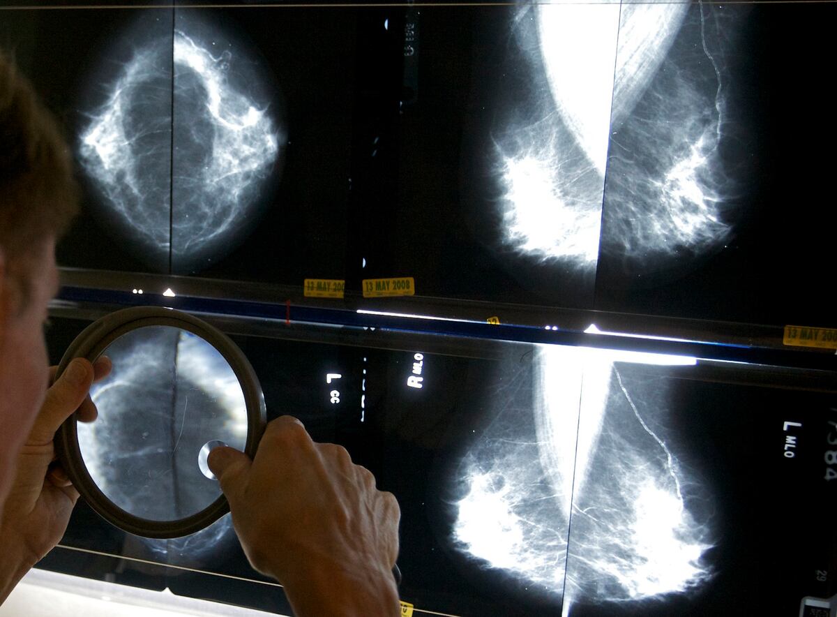 ARCHIVO – Un radiólogo usa una lupa para revisar mamografías y detectar cáncer de mama. (AP Foto/Damian Dovarganes, Archivo)