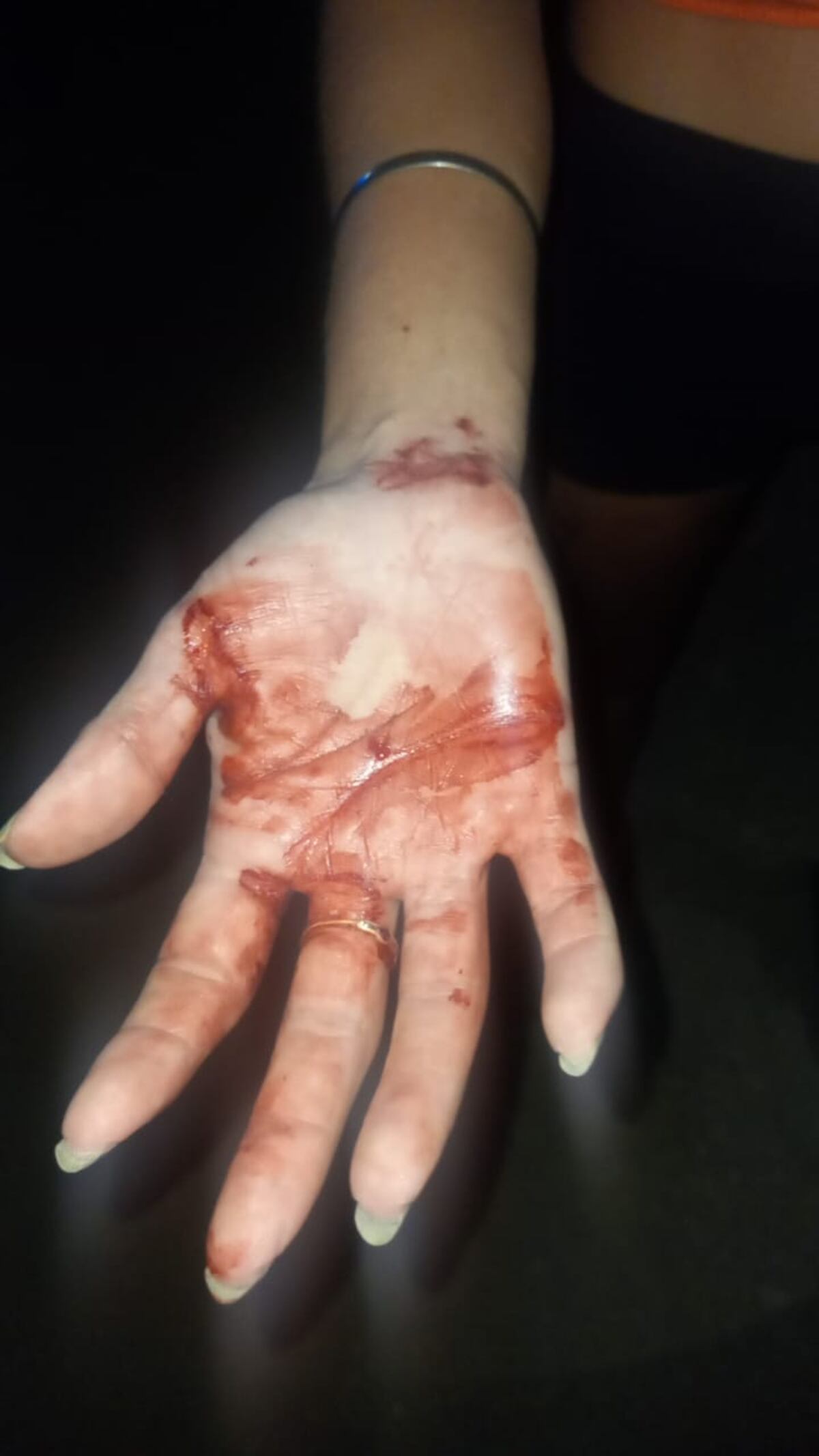 Así quedó la mano de la mujer luego del ataque. (Carlos Paz Vivo)