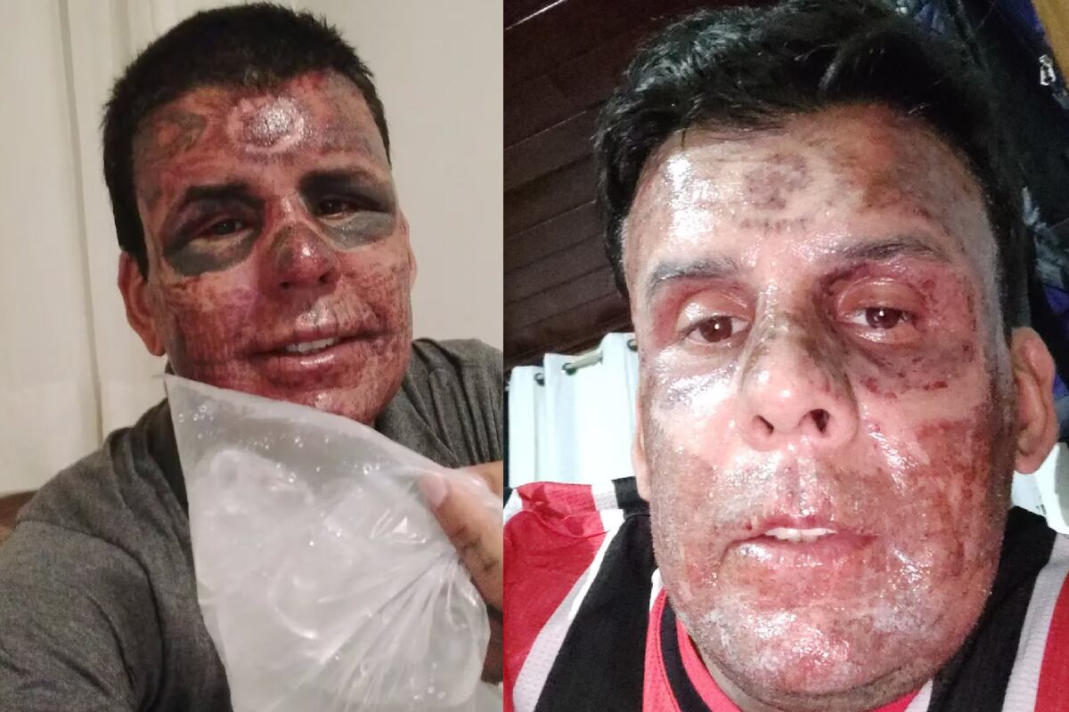 El hombre “más tatuado de Brasil” se empezó a borrar los tatuajes.