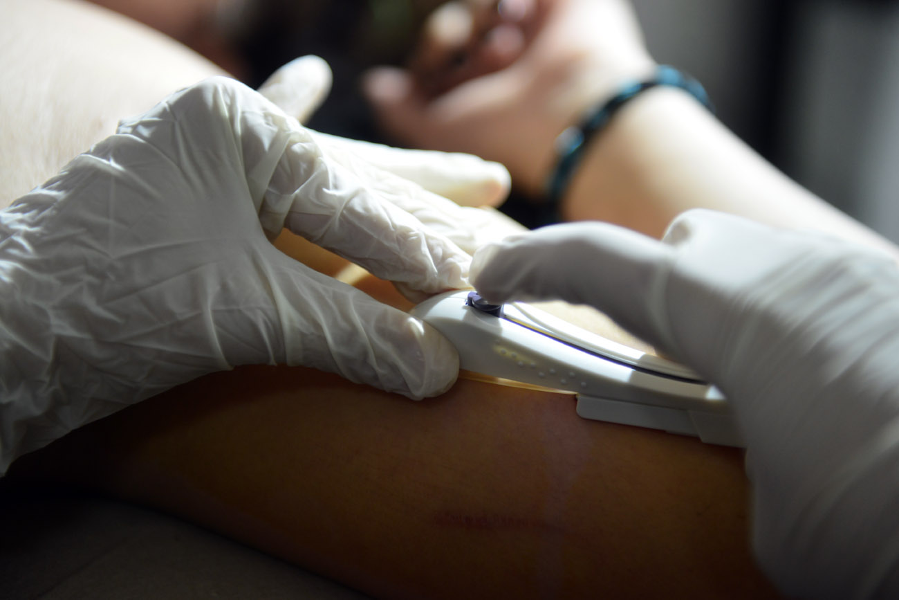 Anmat aprobó un nuevo “chip anticonceptivo”: el 27% de las adolescentes ya usan implantes subdérmicos