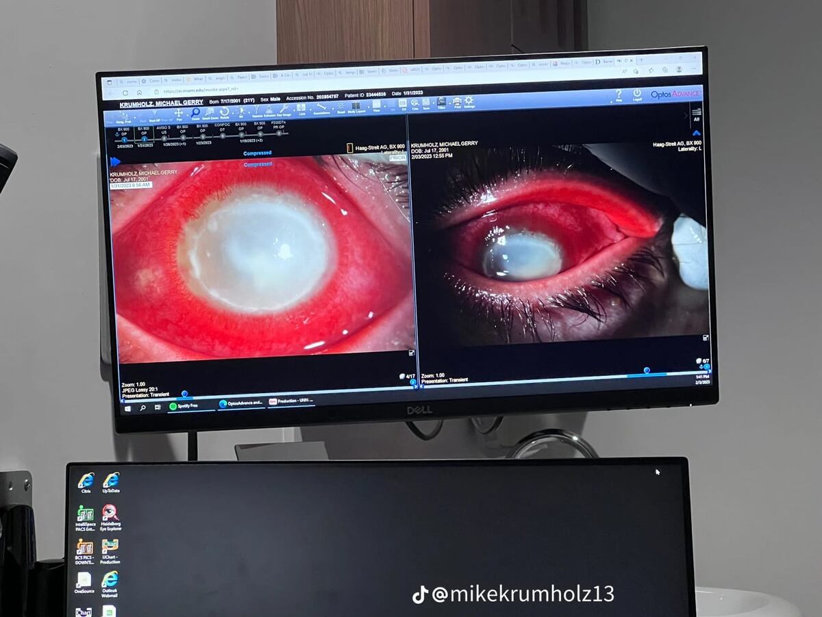 Cuando se despertó se dio cuenta que no veía de un ojo.